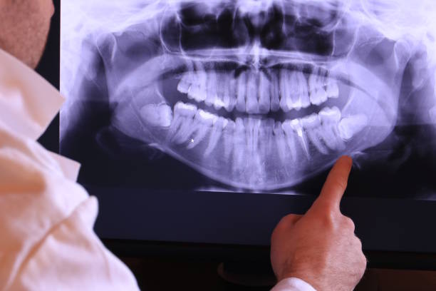 Best Knocked-Out Tooth (Avulsed Tooth) Treatment in Shrub Oak, NY